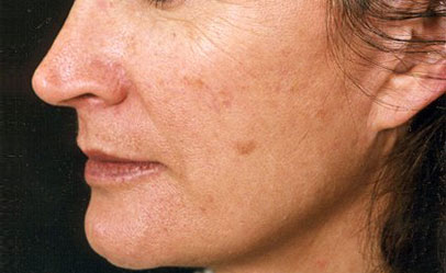 https://www.theskingym.co.uk/wp-content/uploads/2016/03/pigmentation-after-1.jpg
