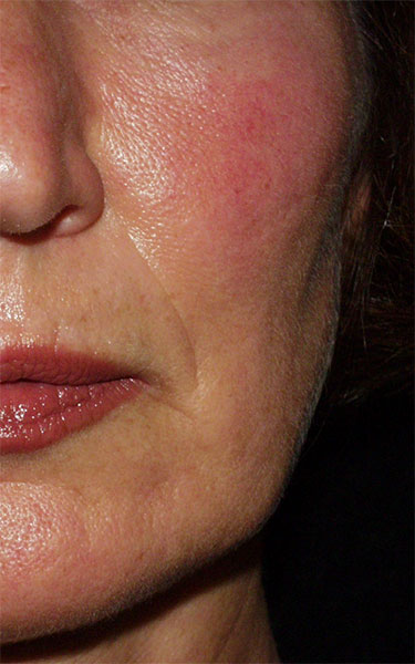 https://www.theskingym.co.uk/wp-content/uploads/2016/03/redness-after.jpg