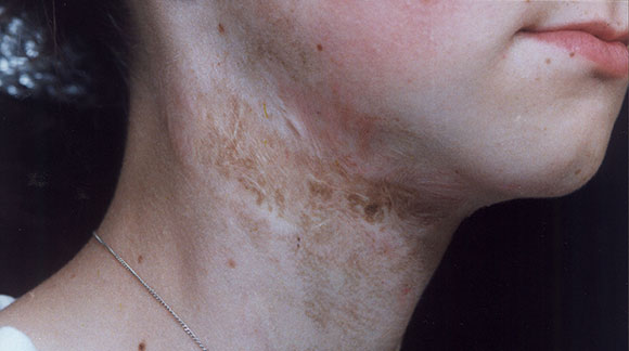 https://www.theskingym.co.uk/wp-content/uploads/2016/03/scarring-after.jpg